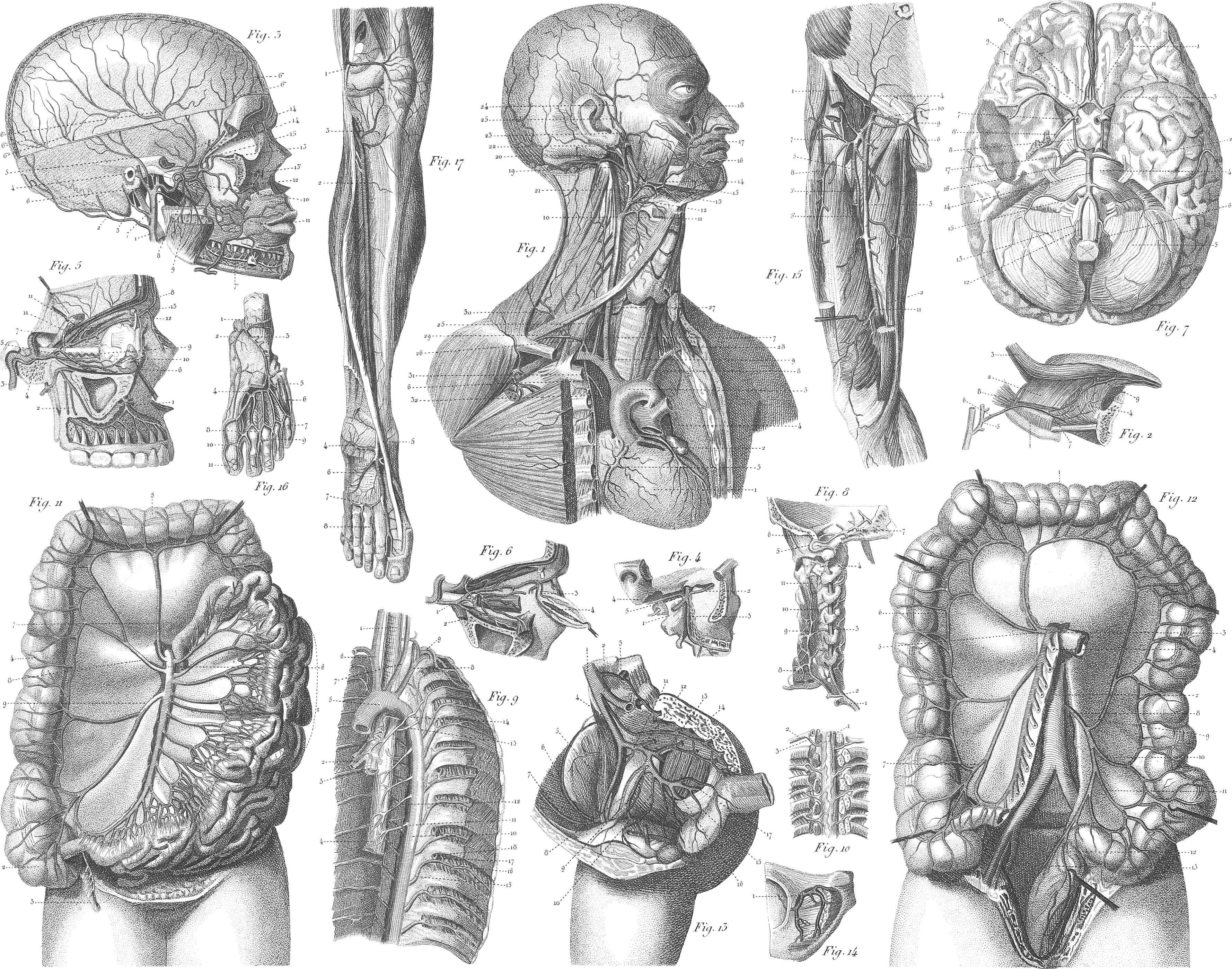 Medical illustration detailing thoracic outlet syndrome. Throw